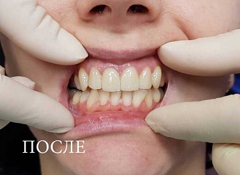 Новые улыбки в Сургуте в рамках акции «Виниры под ключ за 14000 рублей»!